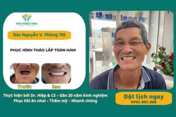 Phục hình tháo lắp toàn hàm