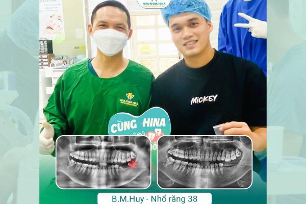 Những nguy cơ tiềm ẩn khi Răng khôn mọc lệch