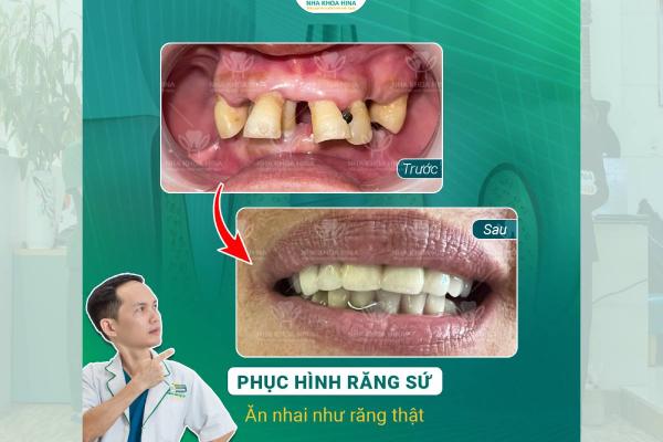 Phục Hình Răng Sứ – Ăn Nhai Vững Vàng, Tự Tin Nụ Cười
