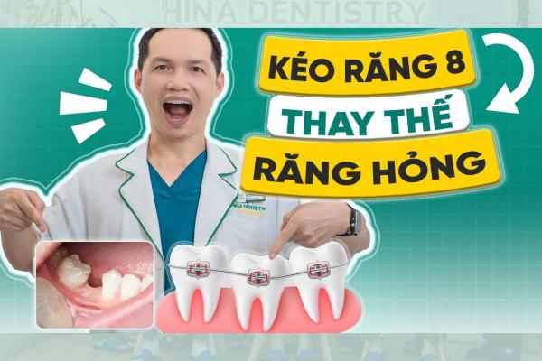 Niềng Răng Cho Trẻ Bị Hỏng Nhiều Răng - Lựa Chọn Tốt Nhất Từ Nha Khoa Hina