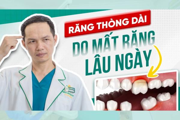 Cách Xử Lý Răng Thòng Dài Khi Răng Đối Diện Mất Lâu Ngày