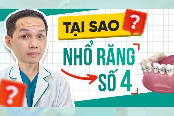 Tại Sao Phải Nhổ Răng 4 Khi Niềng Răng Giảm Hô