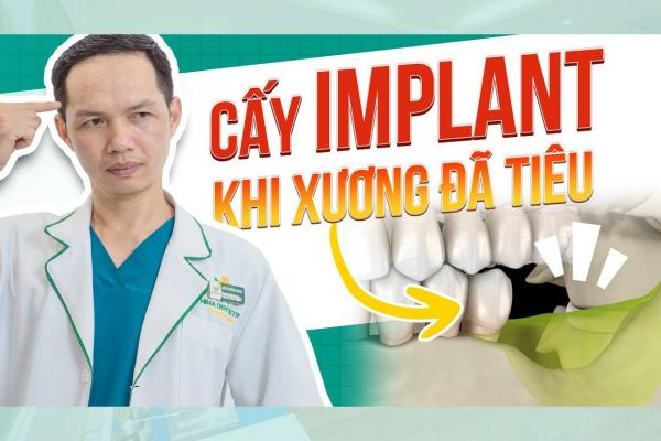 Cấy Implant Khi Xương Đã Tiêu – Bí Quyết Giữ Nụ Cười Bền Đẹp