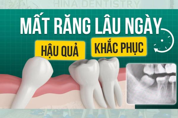 Hậu Quả Mất Răng Lâu Ngày Và Cách Điều Trị Hiệu Quả