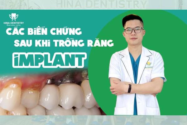 Trồng Răng Implant An Toàn: Cách Tránh Các Biến Chứng Khó Lường 
